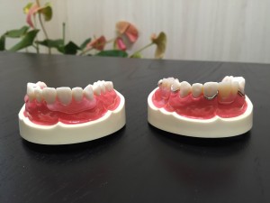 入れ歯　保険と自費の違い2