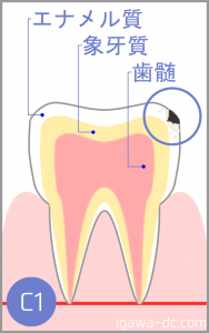 tooth c1 igawadc
