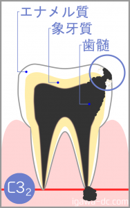 tooth c3-2 igawadc