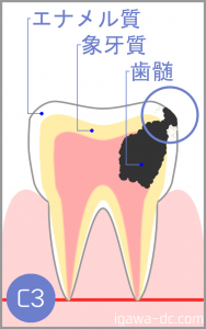 tooth c3 igawadc